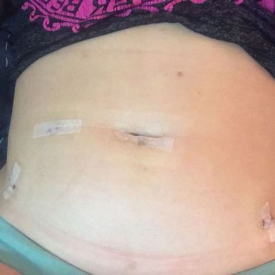 Kellie Johnson's stomach after surgery to manage her endometriosis.