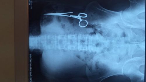 An x-ray of the scissors inside Ma Van Nha's stomach.