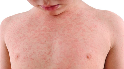 She says her son was unvaccinated when he contracted the measles virus.