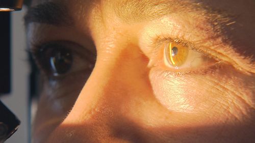 Eksperci ostrzegają przed rakiem oczu, który każdego roku dotyka setki mieszkańców Queensland