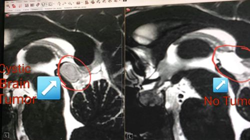 Amelia's MRI scans before and after her lifesaving surgery.