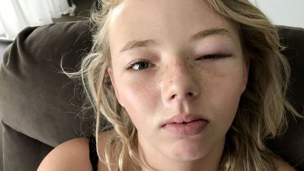 Clare Boulton's daughter Angel with her swollen eye. (Image: Caters News)
